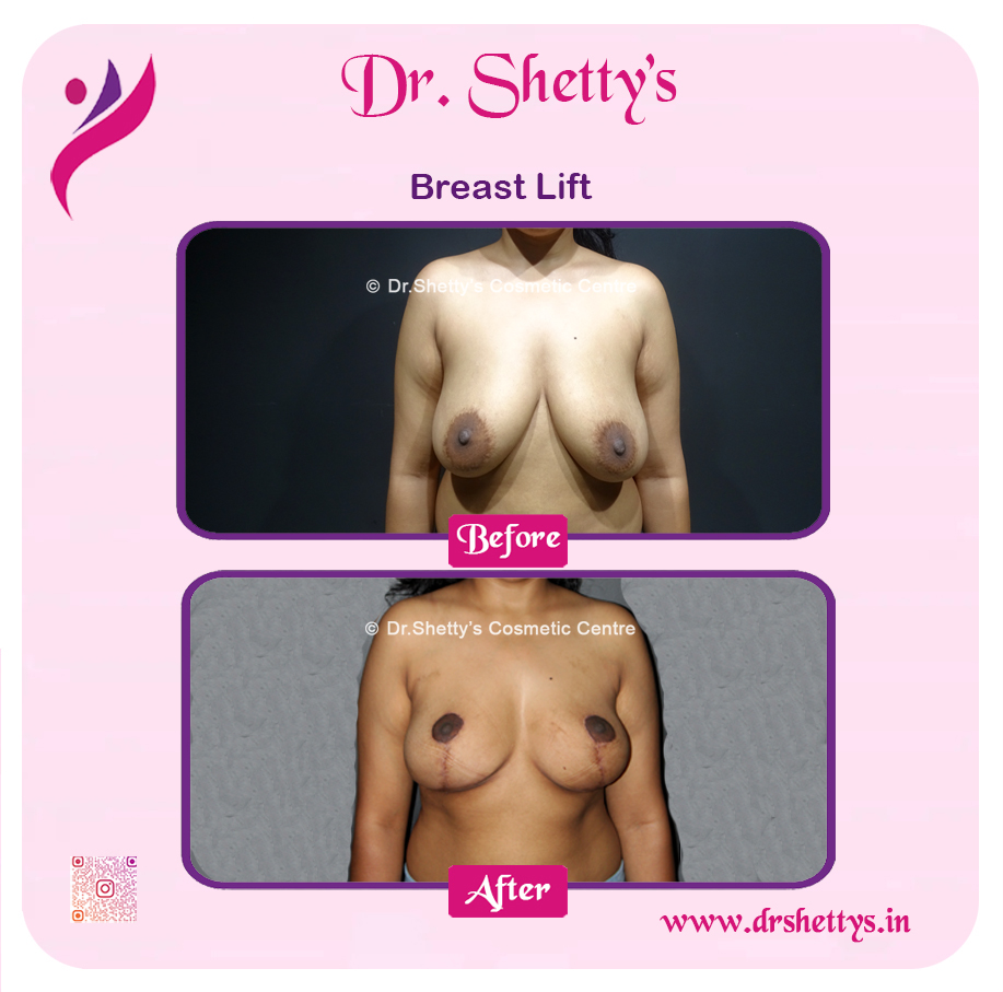 Large Breast Reduction Surgery 6