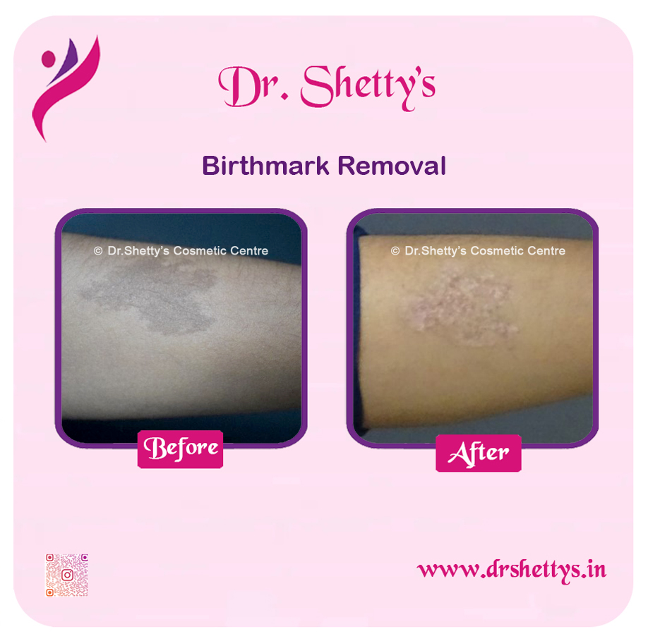 Laser Birthmark Removal 1
