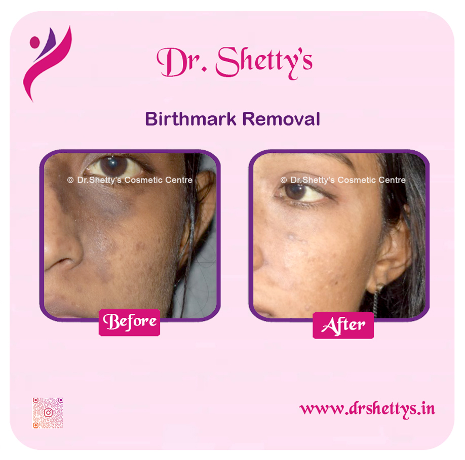 Laser Birthmark Removal 10