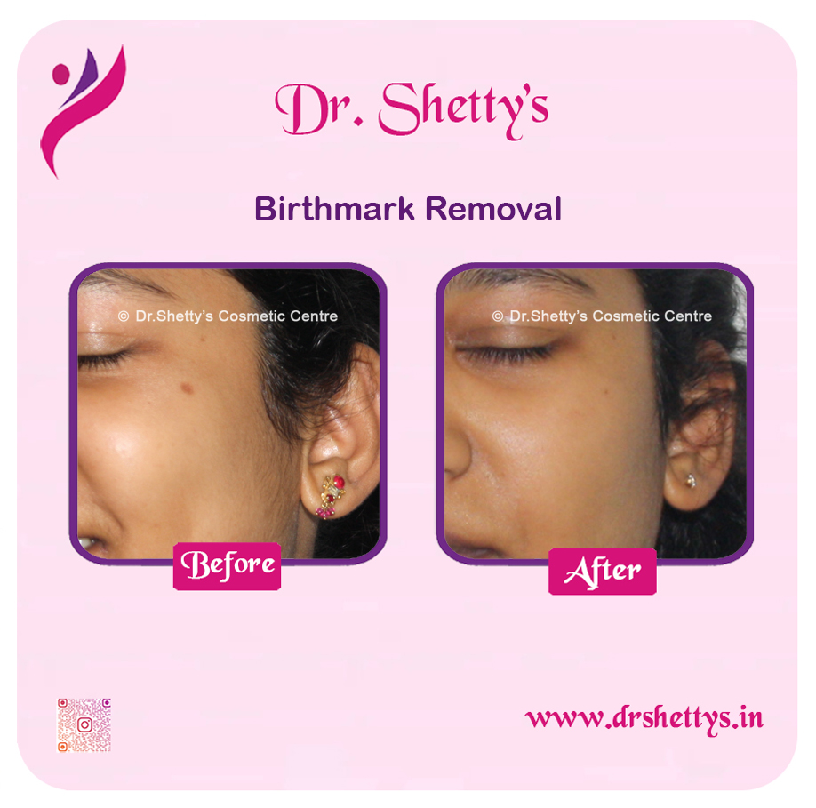 Laser Birthmark Removal 11