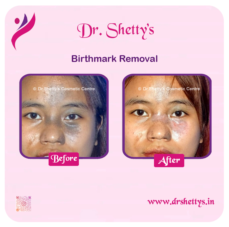 Laser Birthmark Removal 12
