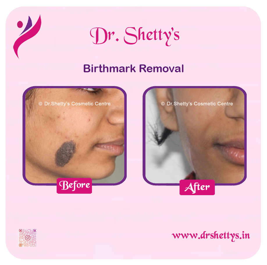 Laser Birthmark Removal 13