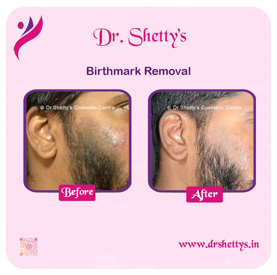 Laser Birthmark Removal 2