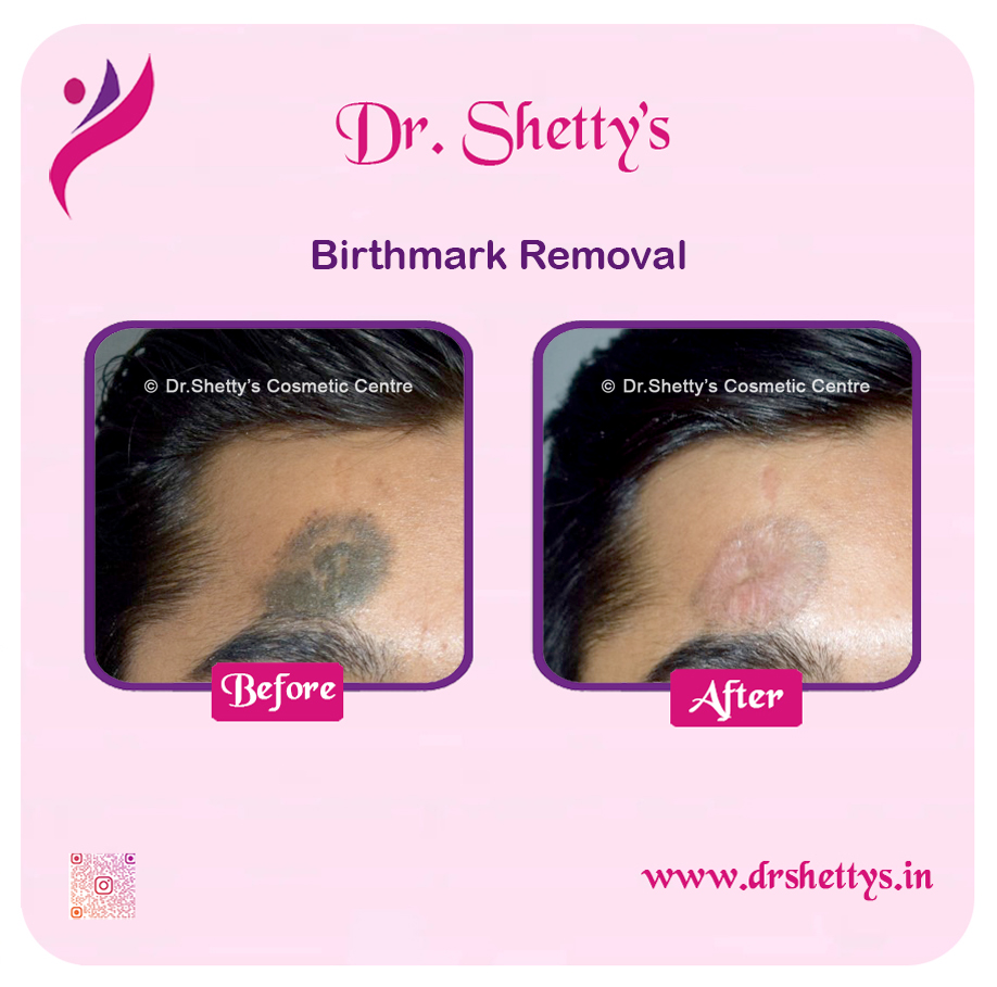Laser Birthmark Removal 3