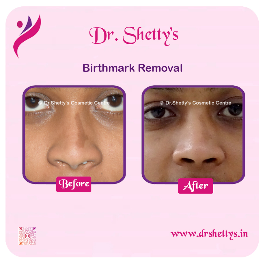 Laser Birthmark Removal 4