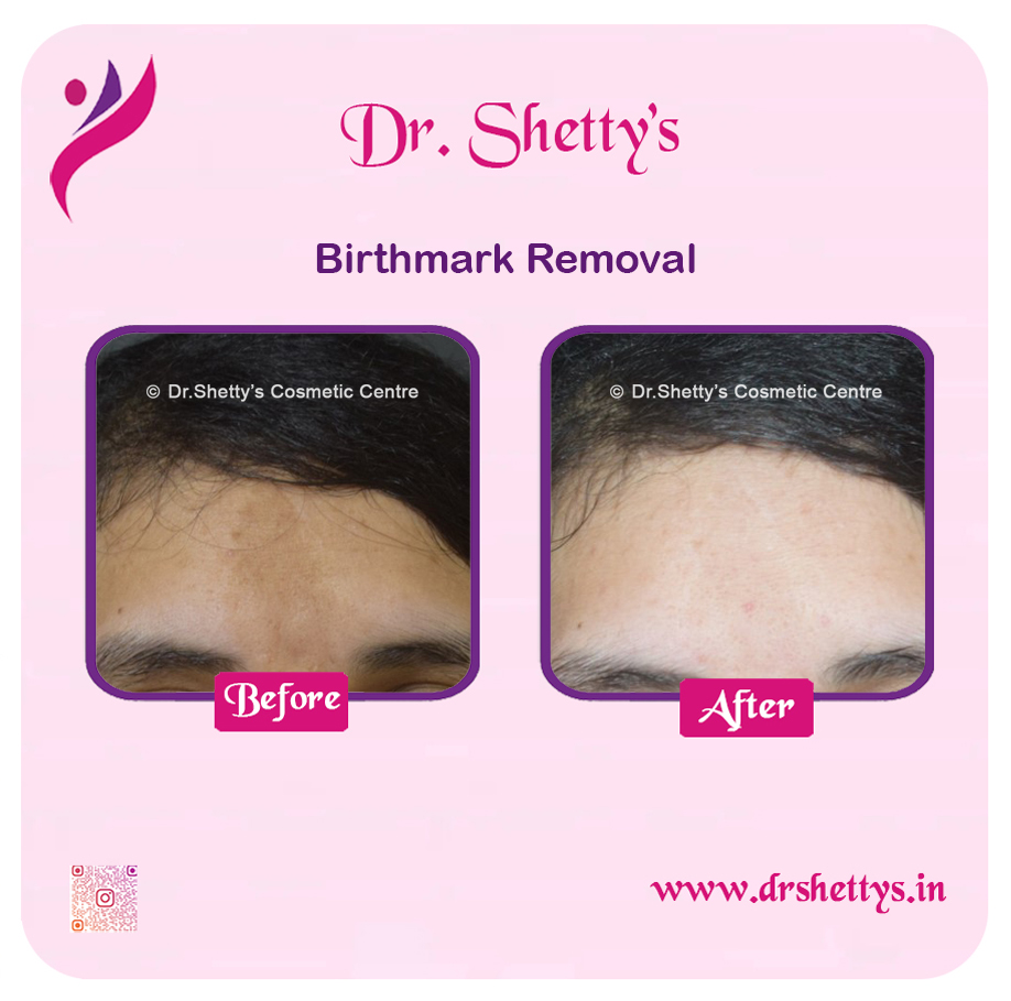 Laser Birthmark Removal 5