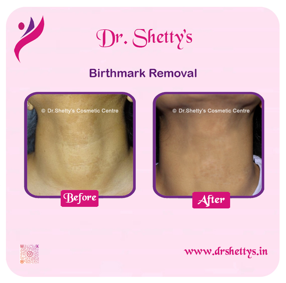 Laser Birthmark Removal 6