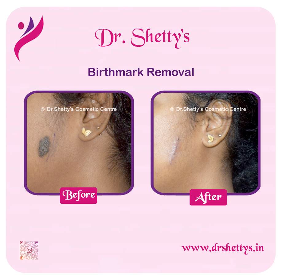 Laser Birthmark Removal 7