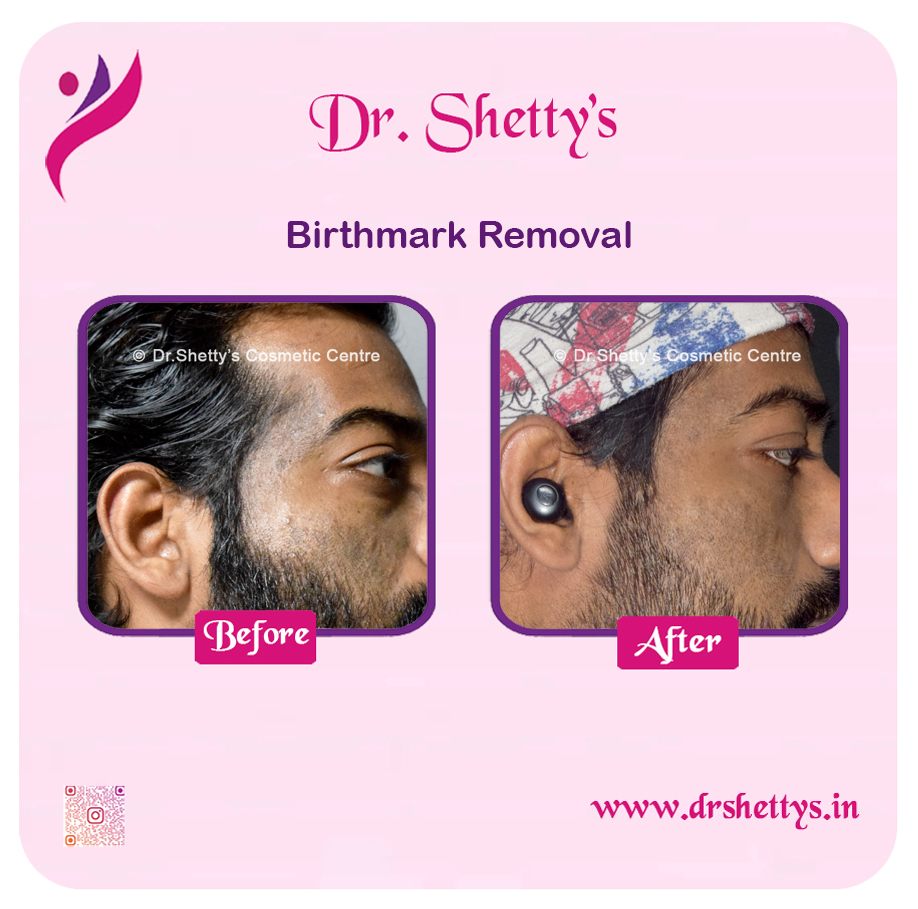 Laser Birthmark Removal 9