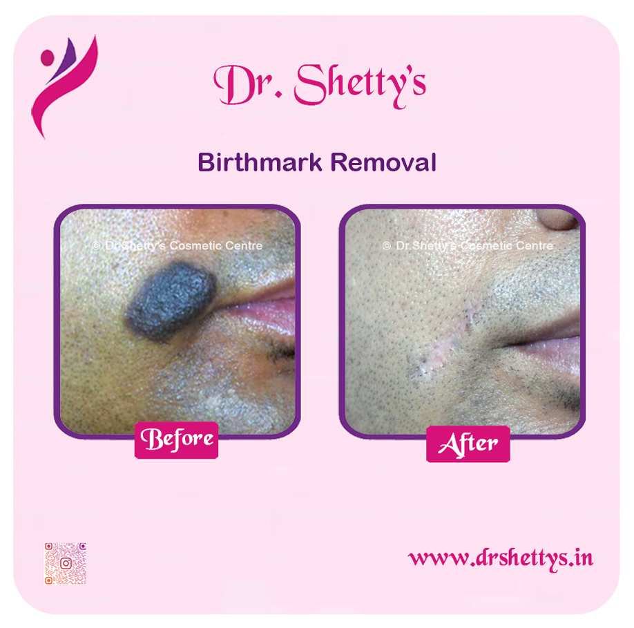 Laser Birthmark Removal