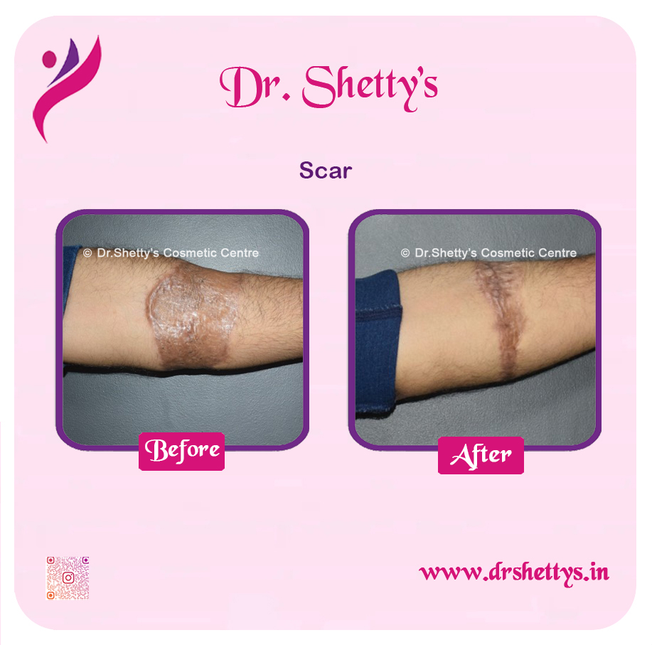 Laser Treatment for Acne Scars 1