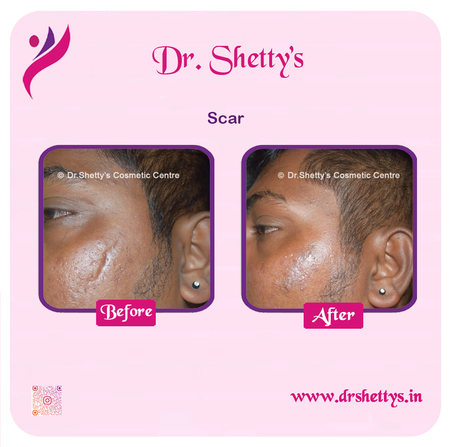Laser Treatment for Acne Scars 10