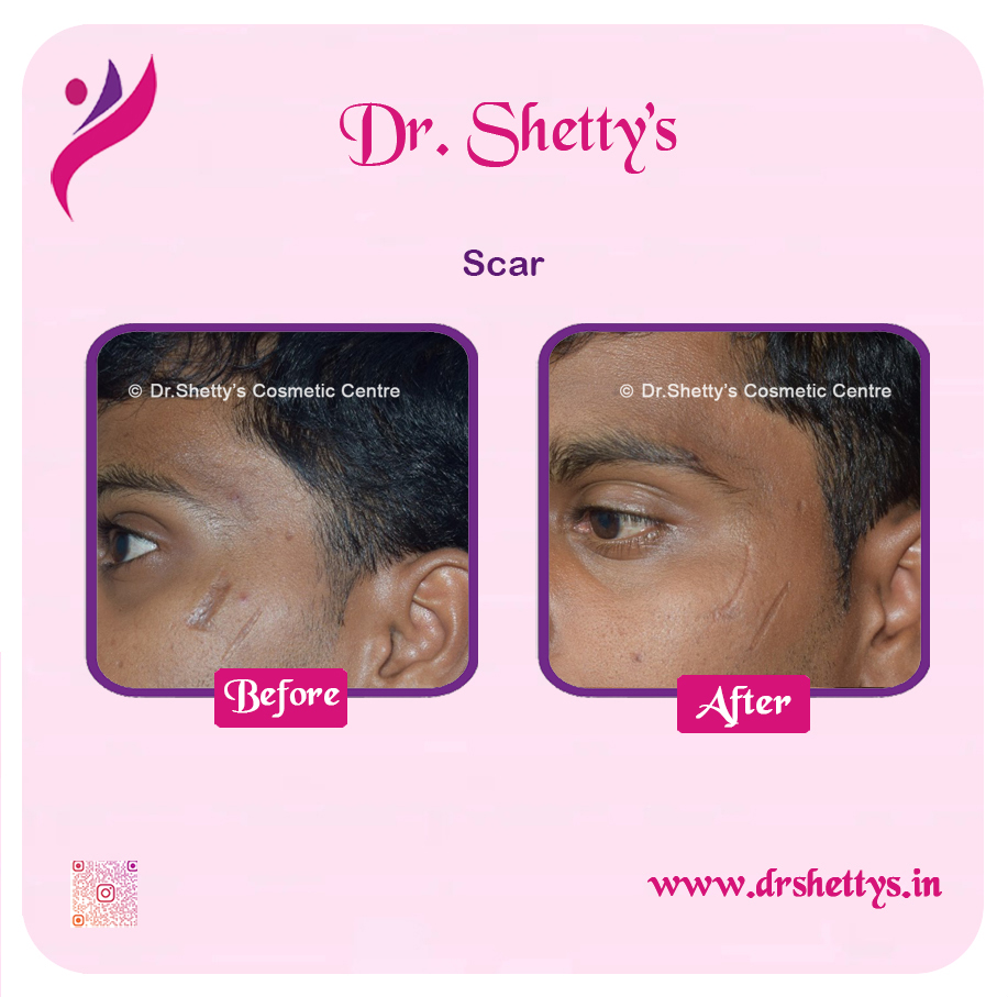 Laser Treatment for Acne Scars 11