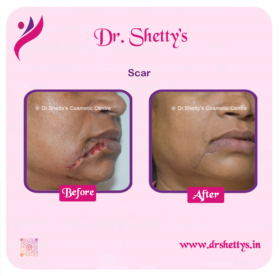 Laser Treatment for Acne Scars 12