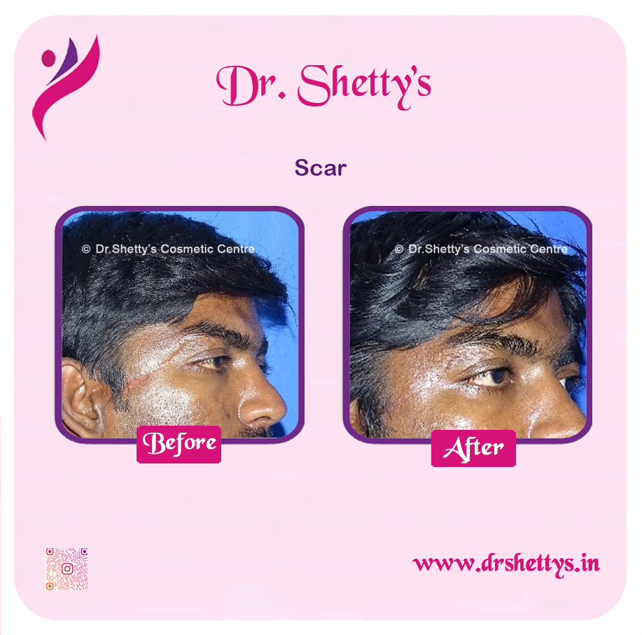 Laser Treatment for Acne Scars 13
