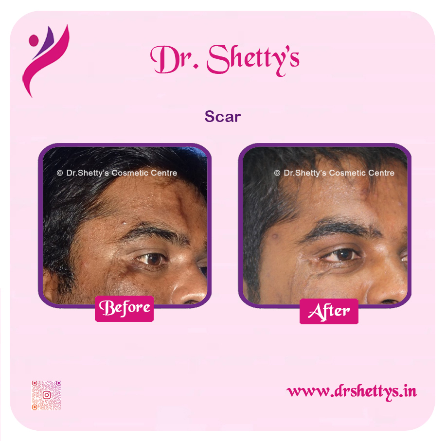 Laser Treatment for Acne Scars 14