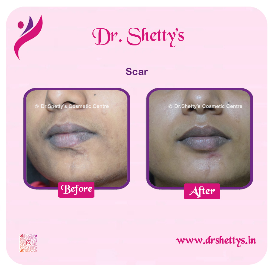 Laser Treatment for Acne Scars 15