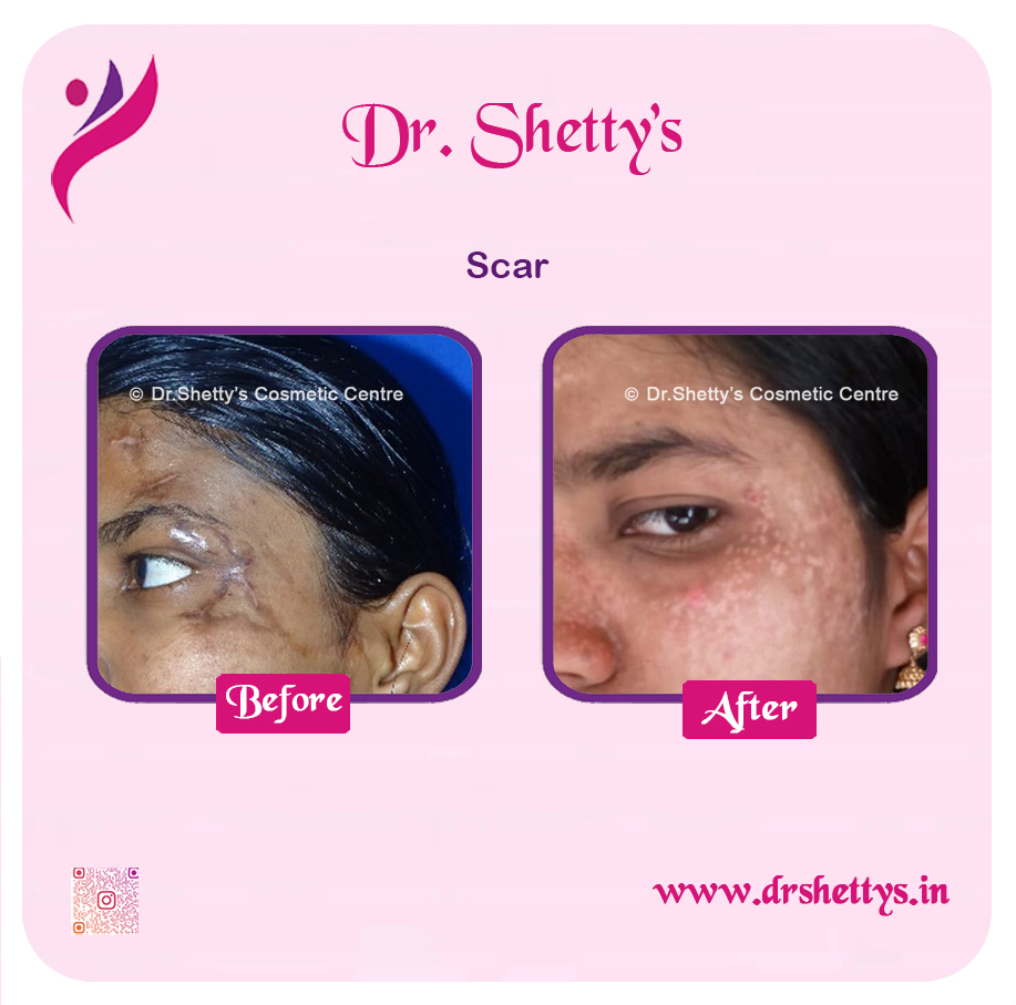 Laser Treatment for Acne Scars 16