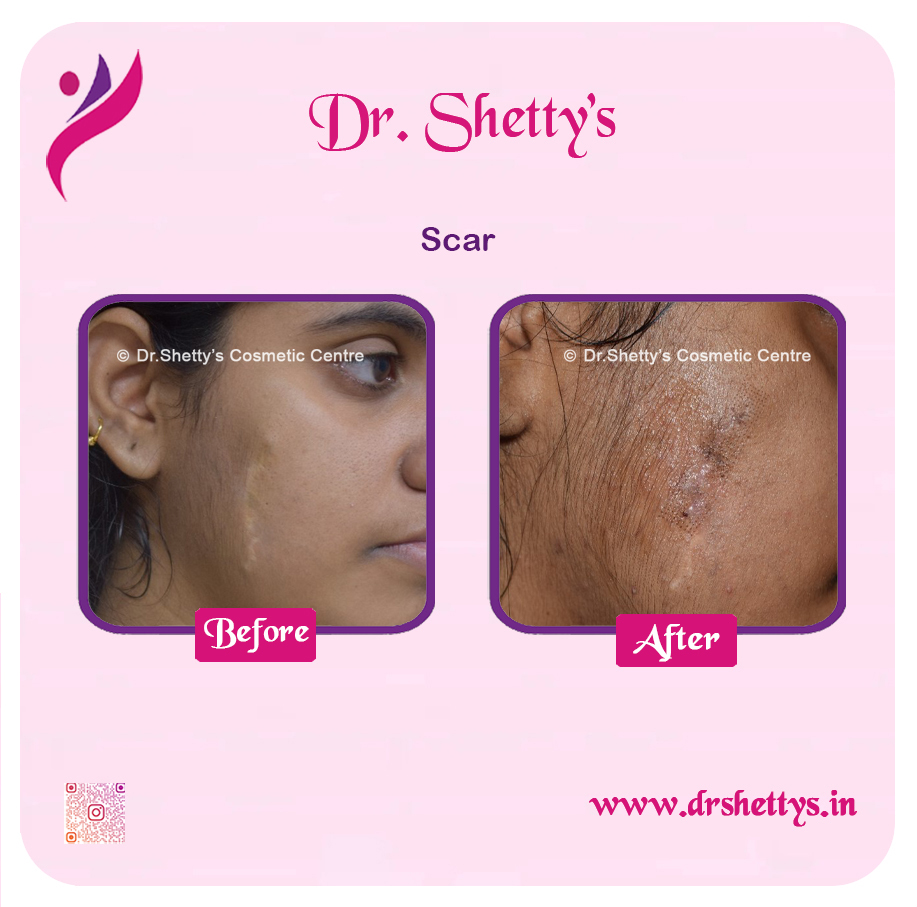 Laser Treatment for Acne Scars 17
