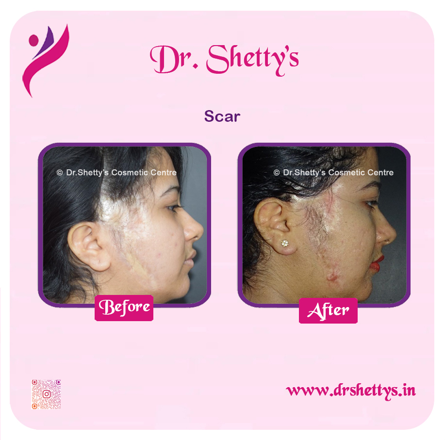 Laser Treatment for Acne Scars 18