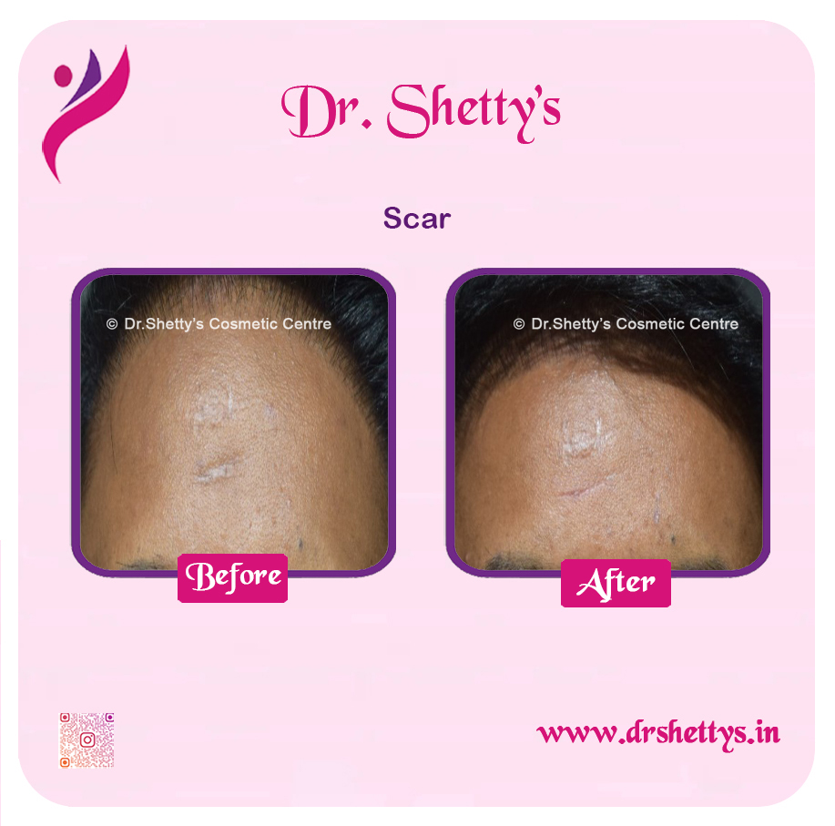 Laser Treatment for Acne Scars 19