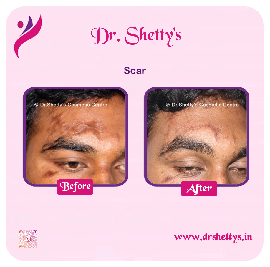 Laser Treatment for Acne Scars 2