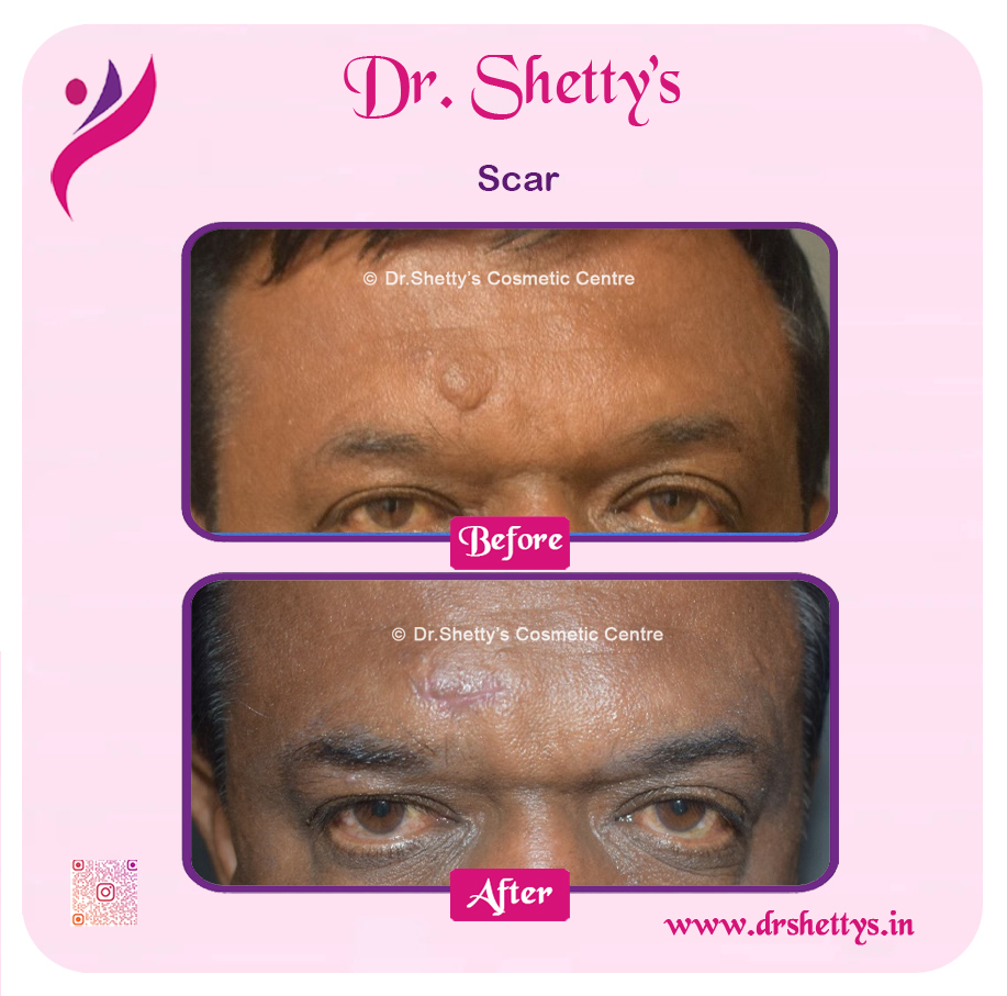 Laser Treatment for Acne Scars 20