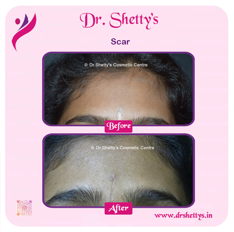 Laser Treatment for Acne Scars 21