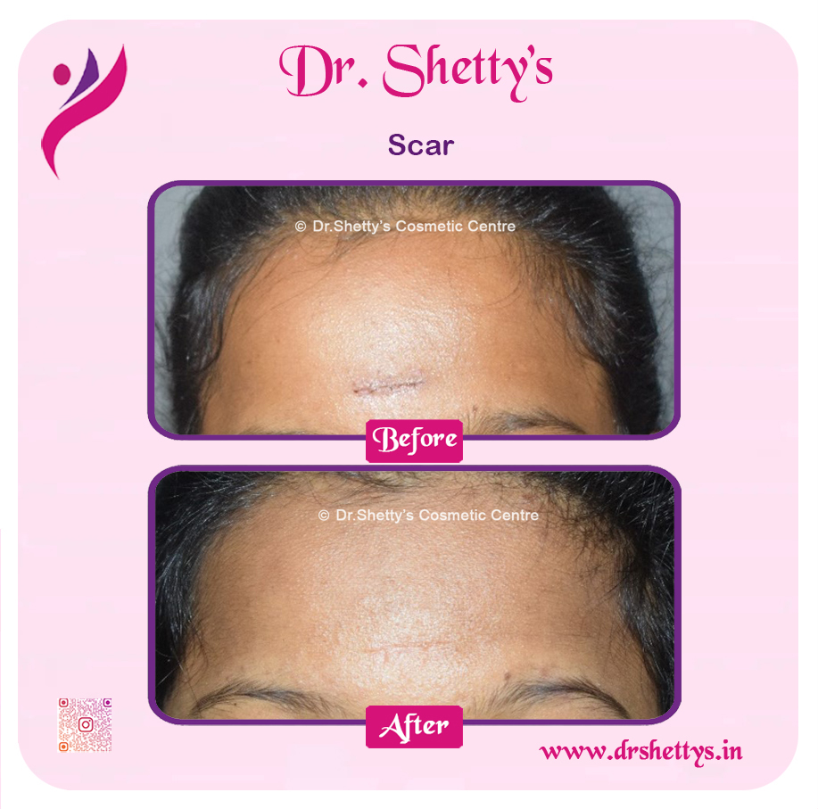 Laser Treatment for Acne Scars 22