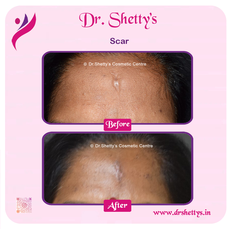 Laser Treatment for Acne Scars 23