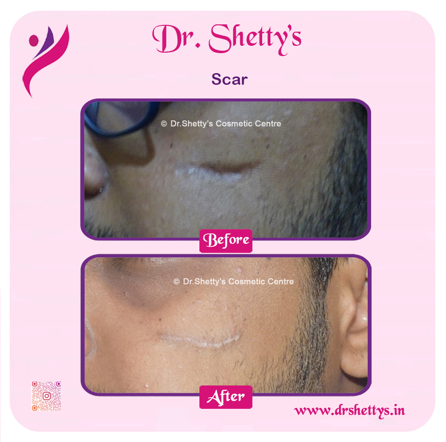 Laser Treatment for Acne Scars 24