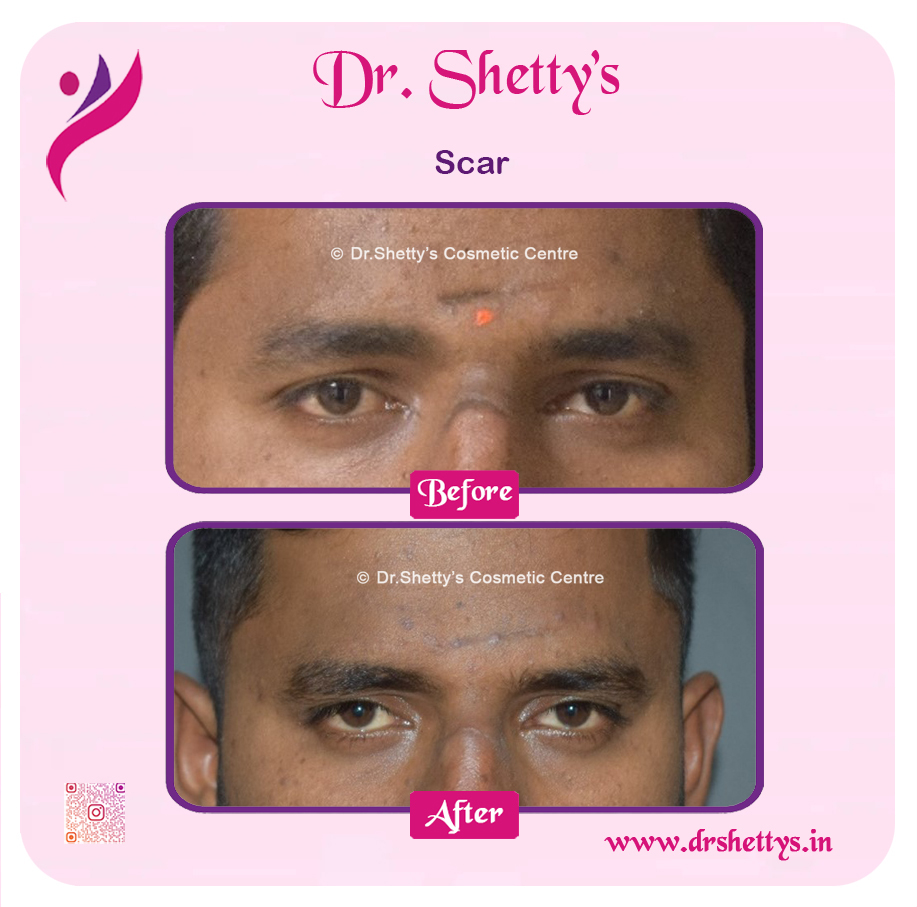 Laser Treatment for Acne Scars 25