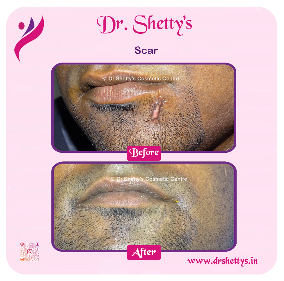Laser Treatment for Acne Scars 26