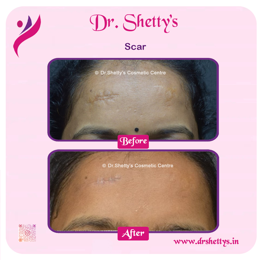 Laser Treatment for Acne Scars 27