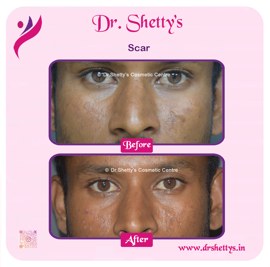 Laser Treatment for Acne Scars 28