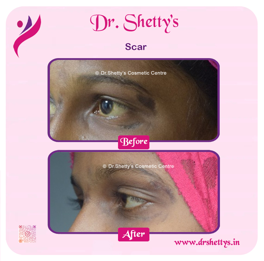 Laser Treatment for Acne Scars 29