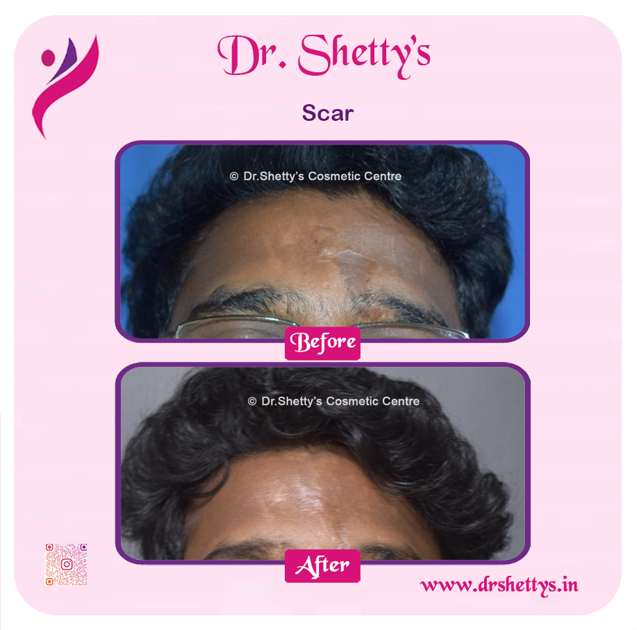 Laser Treatment for Acne Scars 30