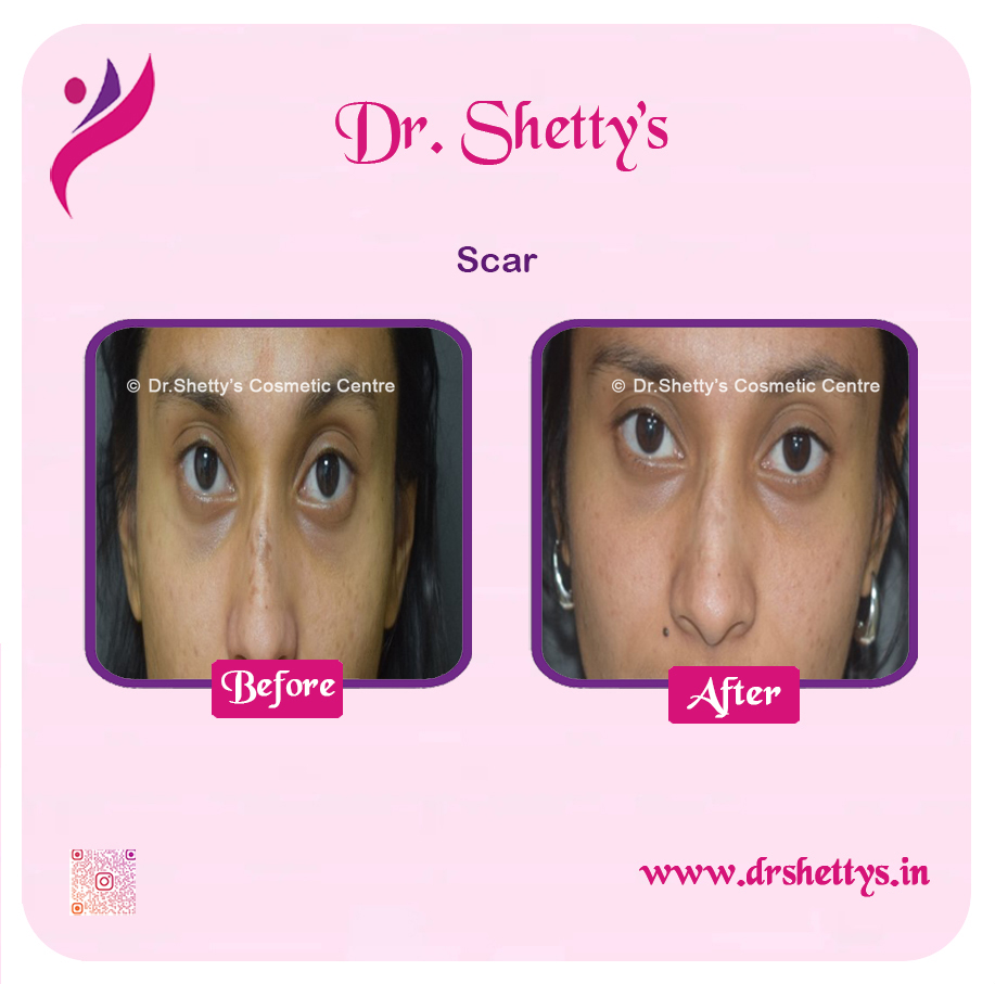 Laser Treatment for Acne Scars 5