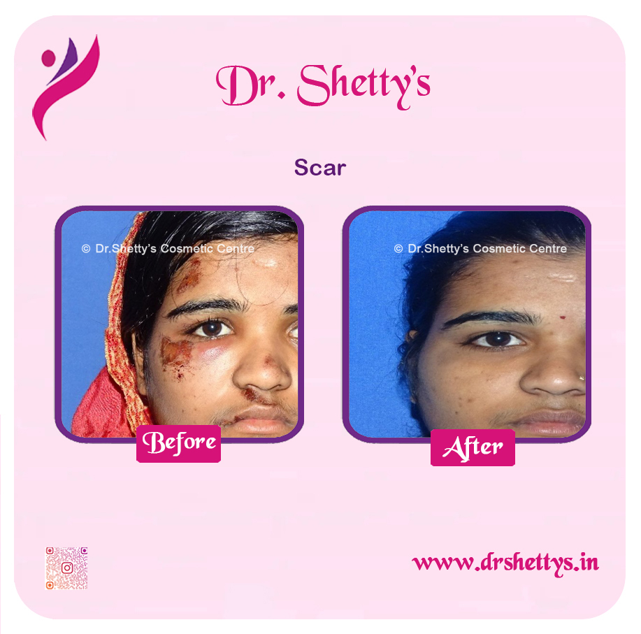 Laser Treatment for Acne Scars 6