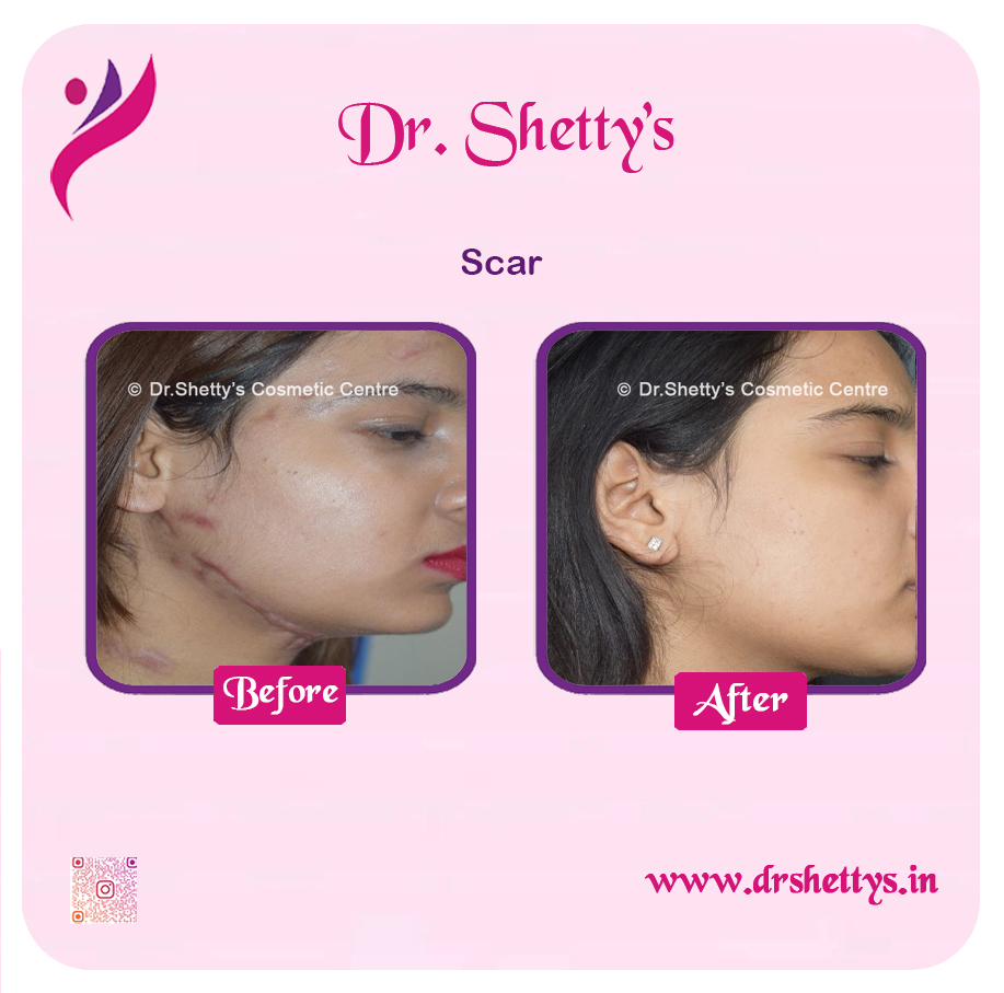 Laser Treatment for Acne Scars 7