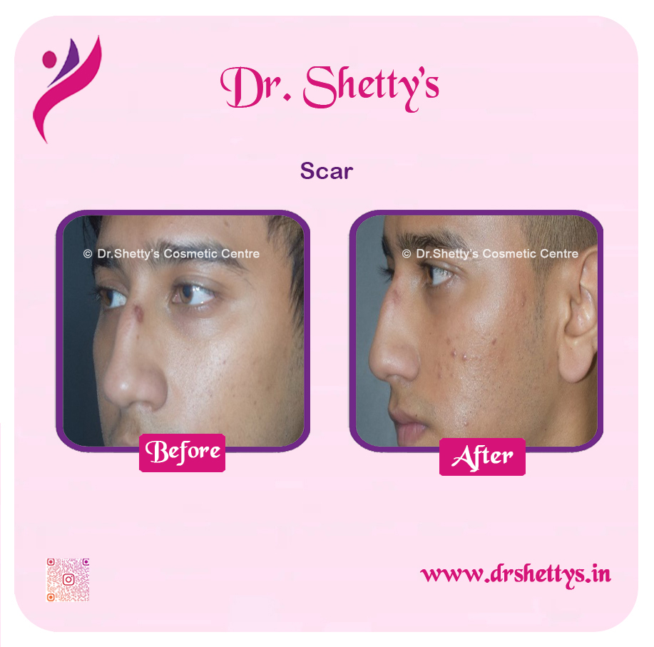 Laser Treatment for Acne Scars 8