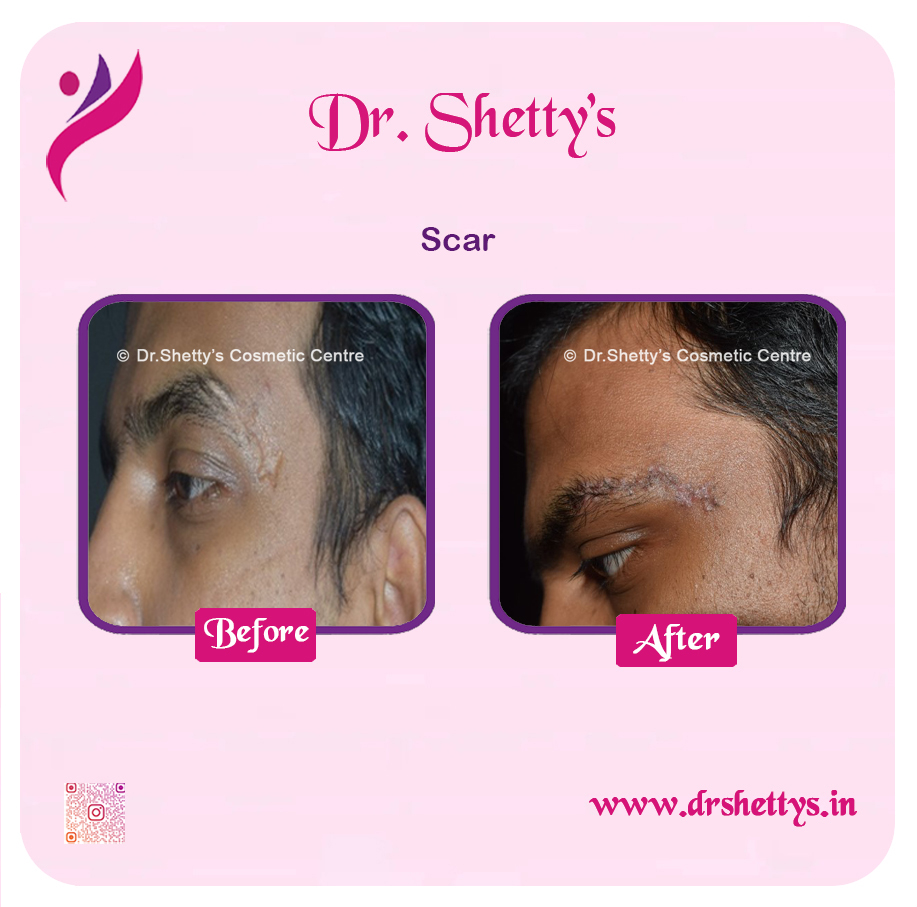Laser Treatment for Acne Scars 9