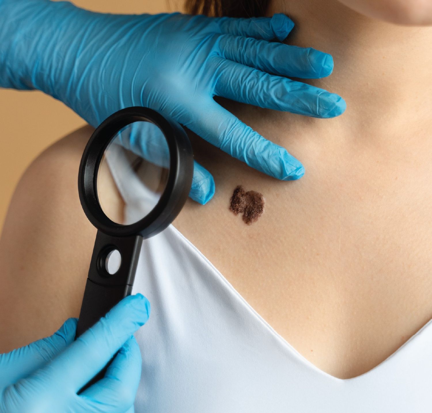 LaserBirthmarkRemoval