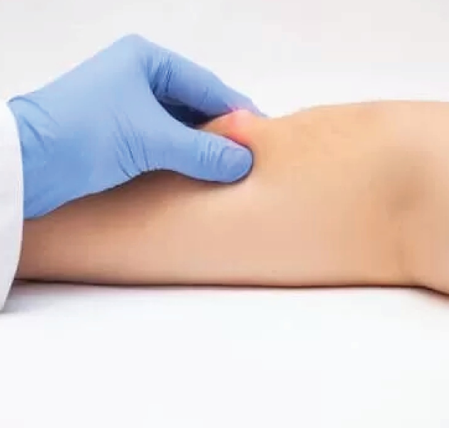 LaserLipomaRemoval