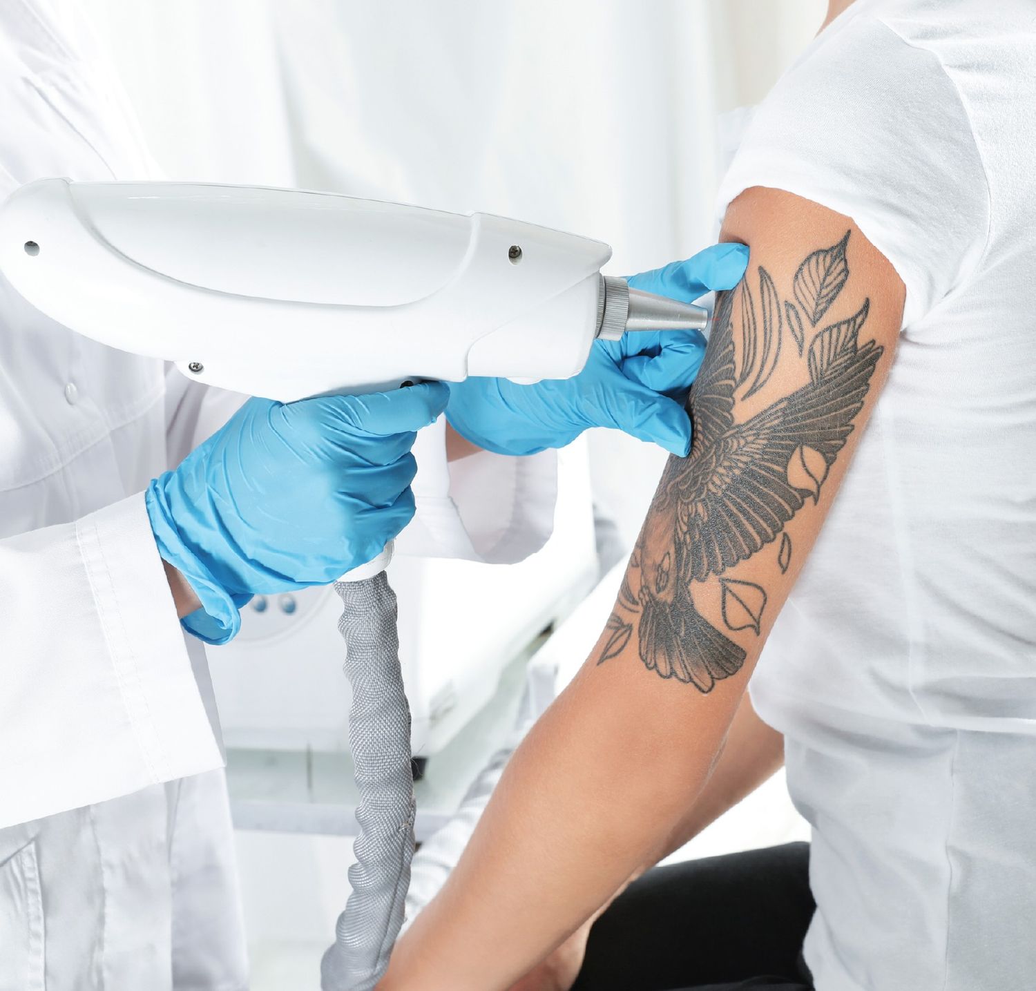 LaserTattooRemoval