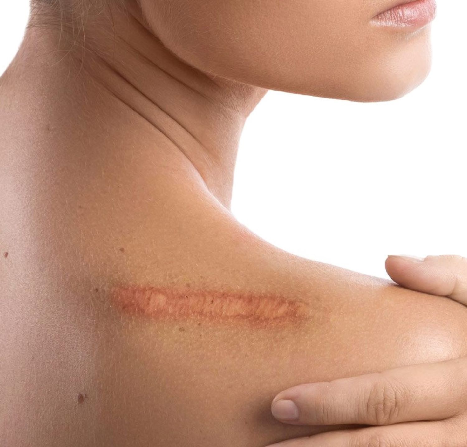 LaserTreatmentforScars