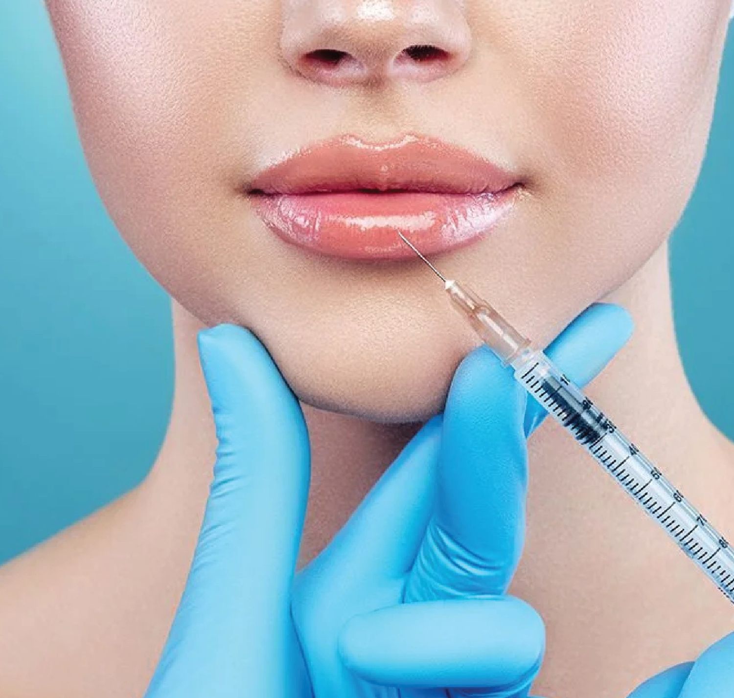 Lip Augmentation withFillers
