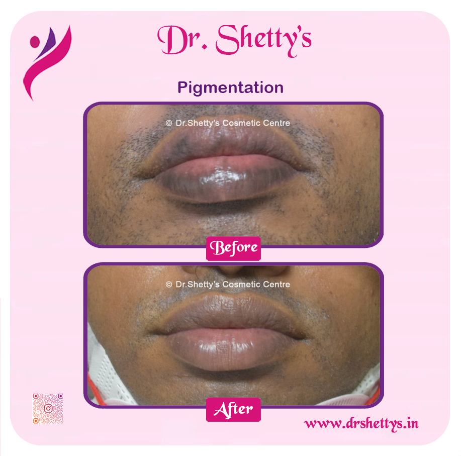 Lip Lightening Treatment 1