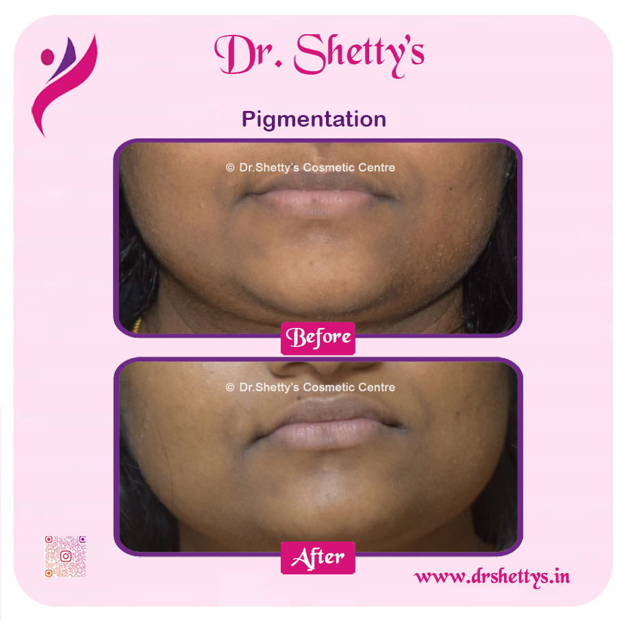Lip Lightening Treatment 10