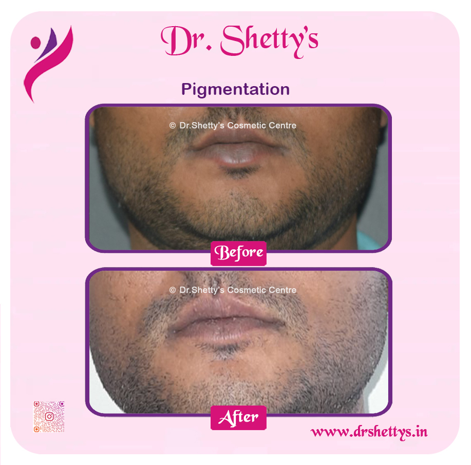 Lip Lightening Treatment 11